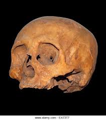 Schädel mit Perforation der Siebbeinzellen Knochen, Zugang ...