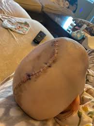 Scaphocephaly repair surgery for 3-month-old baby
