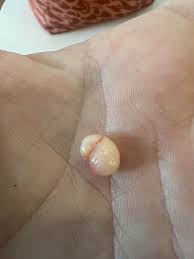 I squeezed a jelly bean out of my scalp : r/popping