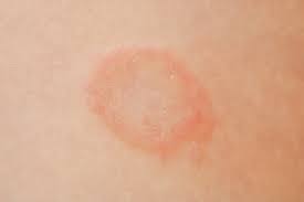 Ringworm 101: What Parents Need to Know and Do | A Private ...