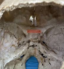 Bones of the Skull and Face Part 2 (Maxilla, zygomatic, palatine, mandible, and sphenoid bone) Flashcards | Quizlet